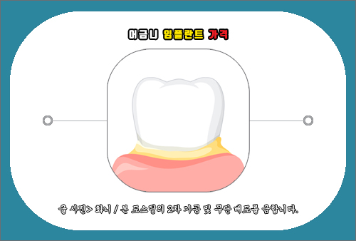 어금니 임플란트 가격